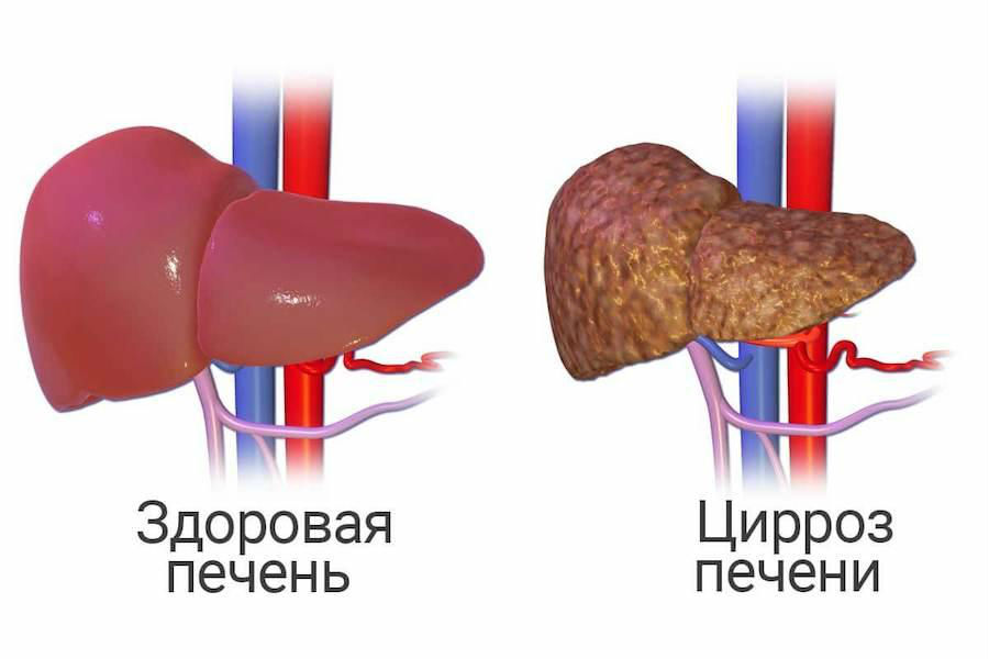 Алкогольная полинейропатия